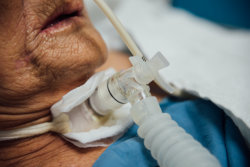 Patient in tracheotomy using ventilator for breathing
